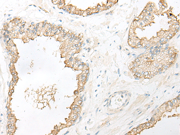 Immunohistochemistry of paraffin-embedded Human prost ate cancer tissue  using DHRS7 Polyclonal Antibody at dilution of 1:30(×200)