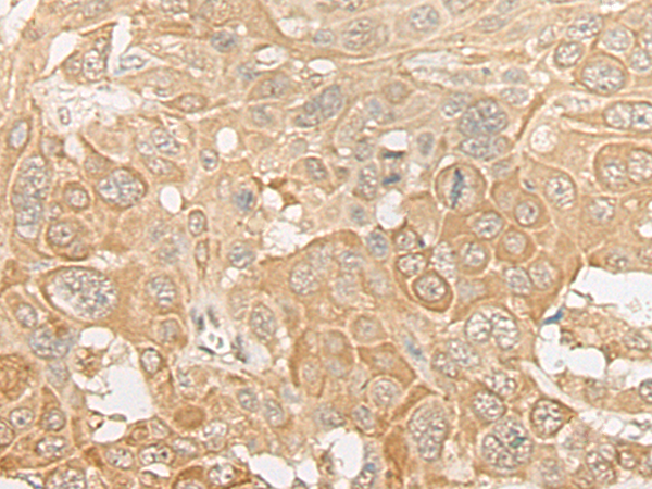 Immunohistochemistry of paraffin-embedded Human esophagus cancer tissue  using ROM1 Polyclonal Antibody at dilution of 1:30(×200)