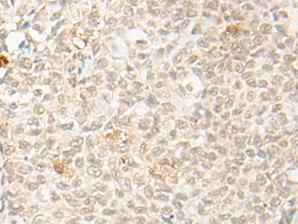 Immunohistochemistry of paraffin-embedded Human ovarian cancer tissue  using OTX1 Polyclonal Antibody at dilution of 1:30(×200)