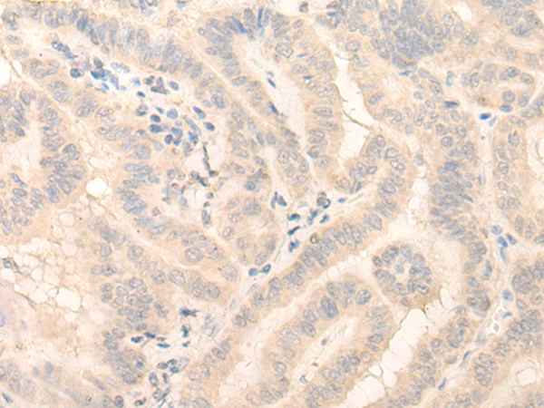 Immunohistochemistry of paraffin-embedded Human thyroid cancer tissue  using HMBS Polyclonal Antibody at dilution of 1:25(×200)