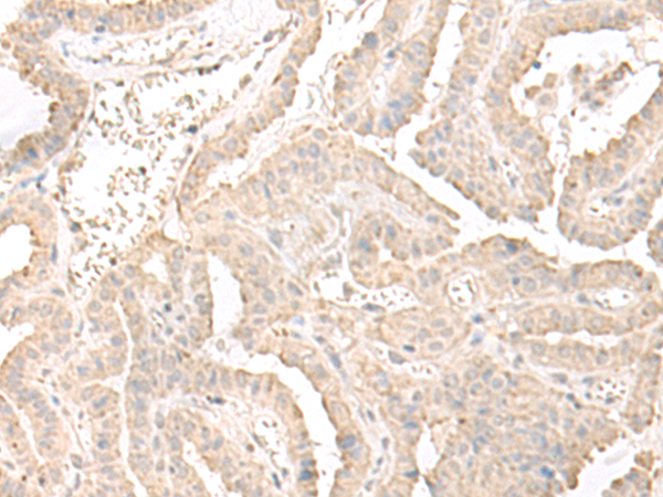 Immunohistochemistry of paraffin-embedded Human thyroid cancer tissue  using ERGIC3 Polyclonal Antibody at dilution of 1:50(×200)