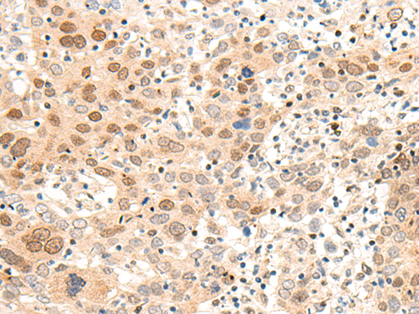 Immunohistochemistry of paraffin-embedded Human cervical cancer tissue  using ARMC8 Polyclonal Antibody at dilution of 1:60(×200)