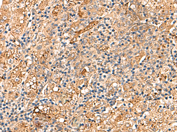 Immunohistochemistry of paraffin-embedded Human liver cancer tissue  using DNAJC14 Polyclonal Antibody at dilution of 1:70(×200)