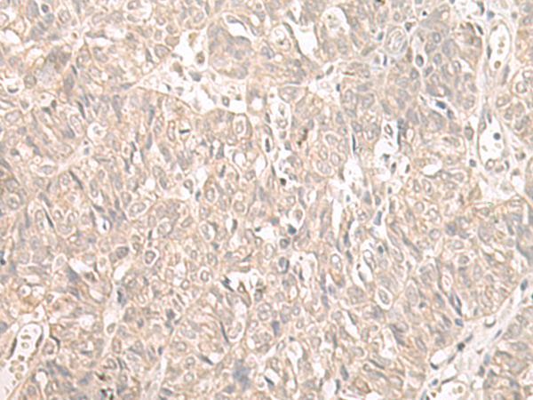 Immunohistochemistry of paraffin-embedded Human ovarian cancer tissue  using ILKAP Polyclonal Antibody at dilution of 1:55(×200)