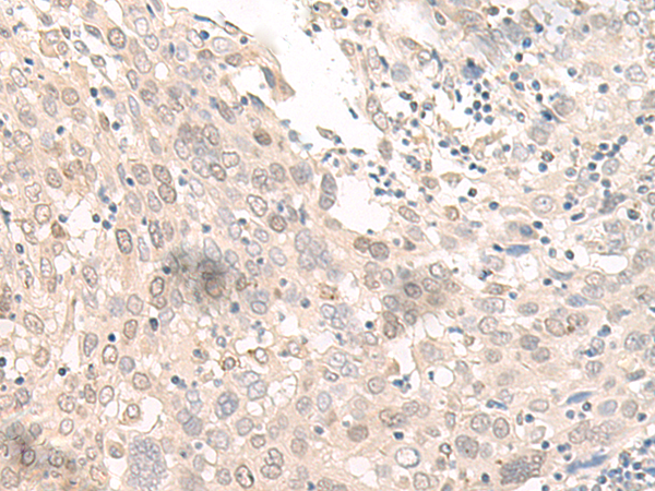Immunohistochemistry of paraffin-embedded Human prost at e cancer tissue  using OLA1 Polyclonal Antibody at dilution of 1:45(×200)