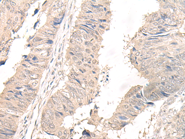 Immunohistochemistry of paraffin-embedded Human lung cancer tissue  using OLA1 Polyclonal Antibody at dilution of 1:45(×200)