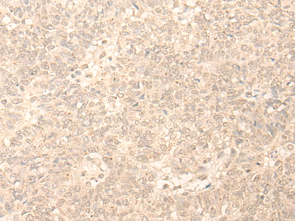 Immunohistochemistry of paraffin-embedded Human ovarian cancer tissue  using PLEKHA1 Polyclonal Antibody at dilution of 1:30(×200)