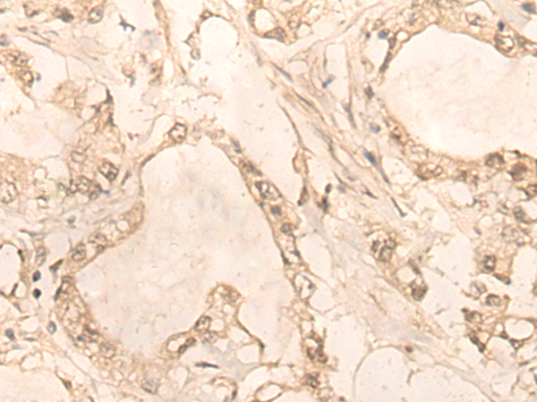 Immunohistochemistry of paraffin-embedded Human gastric cancer tissue  using PLEKHA1 Polyclonal Antibody at dilution of 1:30(×200)