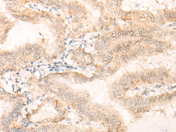 Immunohistochemistry of paraffin-embedded Human thyroid cancer tissue  using EIF4A3 Polyclonal Antibody at dilution of 1:35(×200)