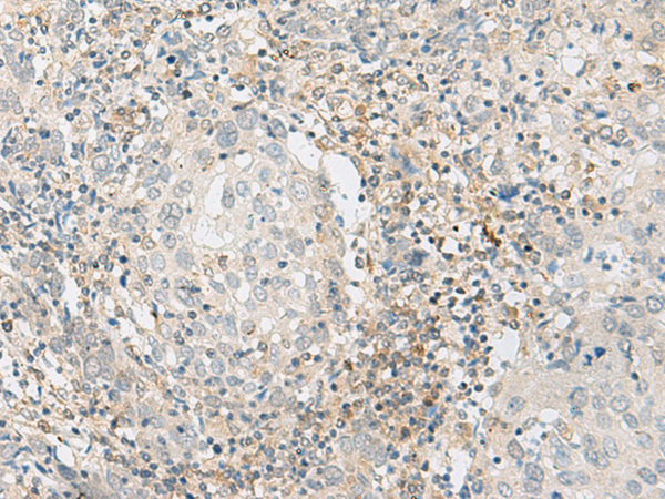 Immunohistochemistry of paraffin-embedded Human cervical cancer tissue  using ZBTB8A Polyclonal Antibody at dilution of 1:70(×200)