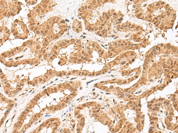 Immunohistochemistry of paraffin-embedded Human thyroid cancer tissue  using ZBTB8A Polyclonal Antibody at dilution of 1:70(×200)