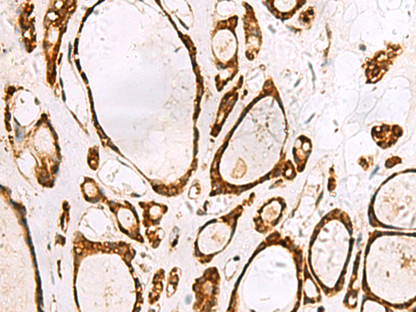 Immunohistochemistry of paraffin-embedded Human thyroid cancer tissue  using GRWD1 Polyclonal Antibody at dilution of 1:55(×200)