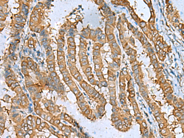Immunohistochemistry of paraffin-embedded Human thyroid cancer tissue  using DPYSL3 Polyclonal Antibody at dilution of 1:55(×200)