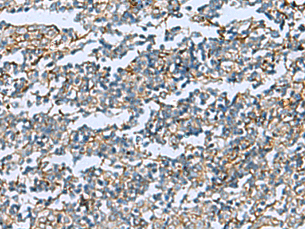 Immunohistochemistry of paraffin-embedded Human tonsil tissue  using DPYSL3 Polyclonal Antibody at dilution of 1:55(×200)