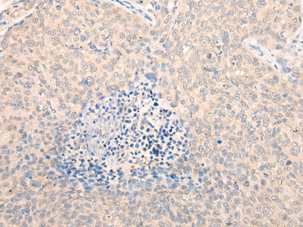 Immunohistochemistry of paraffin-embedded Human cervical cancer tissue  using SEPT10 Polyclonal Antibody at dilution of 1:25(×200)