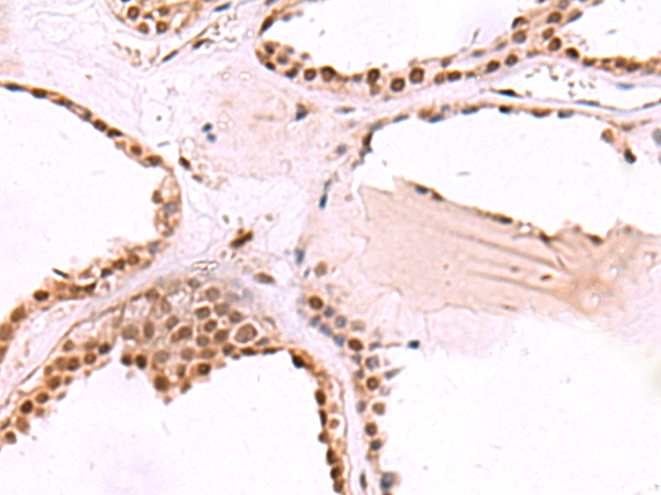 Immunohistochemistry of paraffin-embedded Human thyroid cancer tissue  using RUVBL1 Polyclonal Antibody at dilution of 1:65(×200)