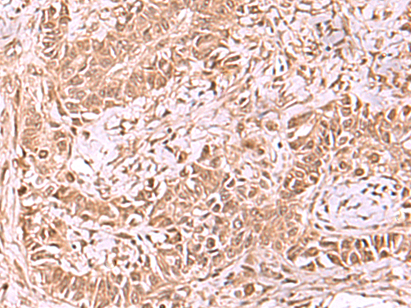 Immunohistochemistry of paraffin-embedded Human ovarian cancer tissue  using RUVBL1 Polyclonal Antibody at dilution of 1:65(×200)