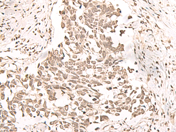 Immunohistochemistry of paraffin-embedded Human lung cancer tissue  using RRP1 Polyclonal Antibody at dilution of 1:40(×200)