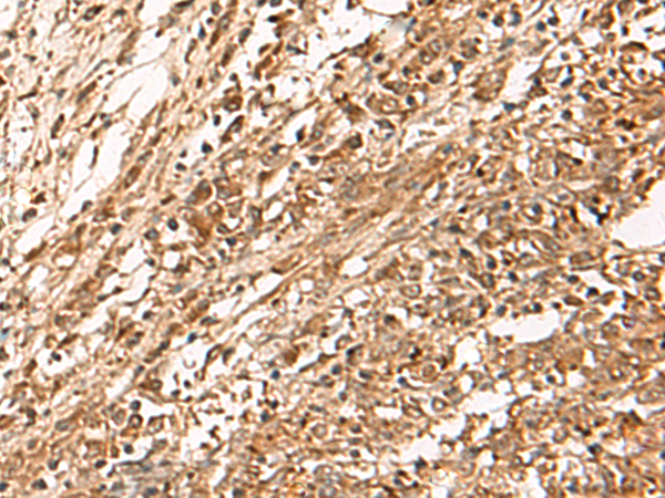 Immunohistochemistry of paraffin-embedded Human liver cancer tissue  using ZBTB43 Polyclonal Antibody at dilution of 1:90(×200)