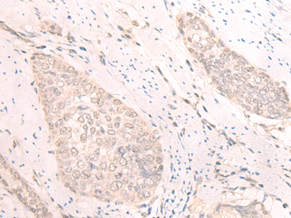 Immunohistochemistry of paraffin-embedded Human esophagus cancer tissue  using TBC1D2 Polyclonal Antibody at dilution of 1:25(×200)