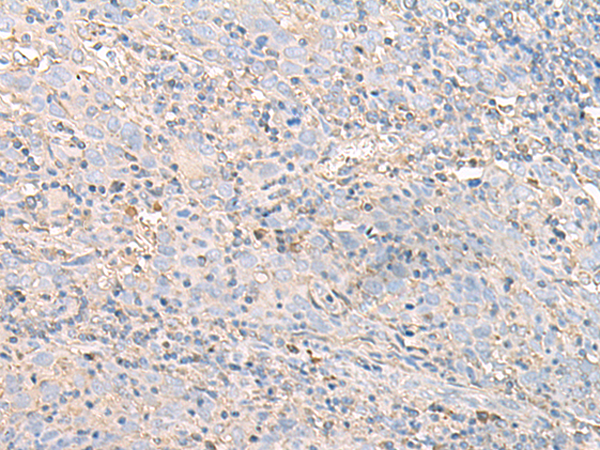 Immunohistochemistry of paraffin-embedded Human cervical cancer tissue  using IGHA1 Polyclonal Antibody at dilution of 1:50(×200)