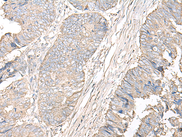 Immunohistochemistry of paraffin-embedded Human colorectal cancer tissue  using IGHA1 Polyclonal Antibody at dilution of 1:50(×200)
