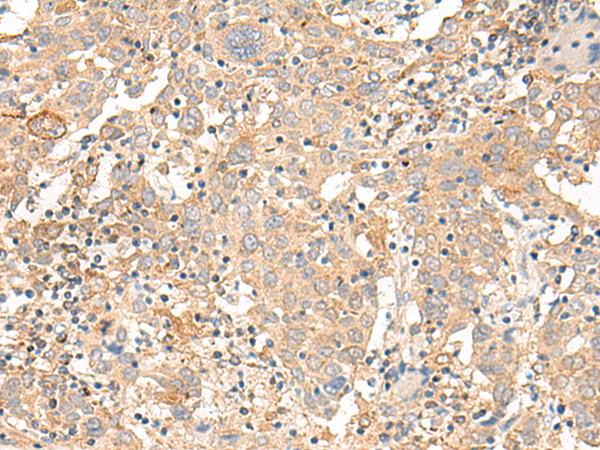 Immunohistochemistry of paraffin-embedded Human cervical cancer tissue  using CORO2A Polyclonal Antibody at dilution of 1:30(×200)