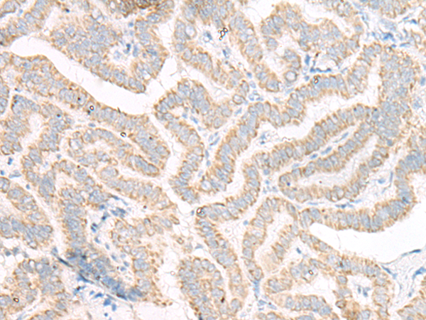 Immunohistochemistry of paraffin-embedded Human thyroid cancer tissue  using ACSF2 Polyclonal Antibody at dilution of 1:30(×200)