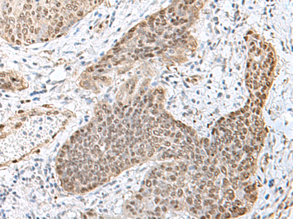 Immunohistochemistry of paraffin-embedded Human esophagus cancer tissue  using TCF25 Polyclonal Antibody at dilution of 1:40(×200)