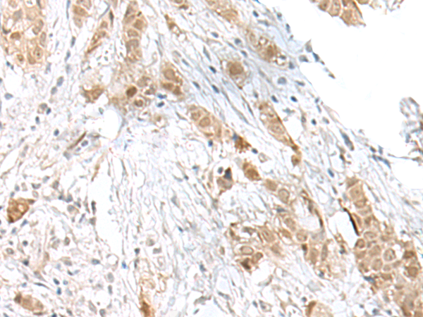 Immunohistochemistry of paraffin-embedded Human breast cancer tissue  using TCF25 Polyclonal Antibody at dilution of 1:40(×200)