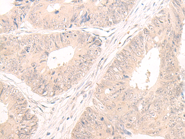 Immunohistochemistry of paraffin-embedded Human colorectal cancer tissue  using LCMT2 Polyclonal Antibody at dilution of 1:55(×200)