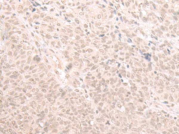 Immunohistochemistry of paraffin-embedded Human ovarian cancer tissue  using HOOK2 Polyclonal Antibody at dilution of 1:30(×200)
