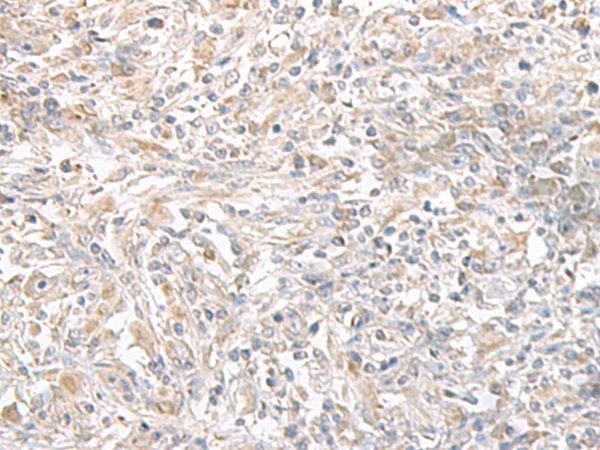 Immunohistochemistry of paraffin-embedded Human liver cancer tissue  using PFKM Polyclonal Antibody at dilution of 1:50(×200)