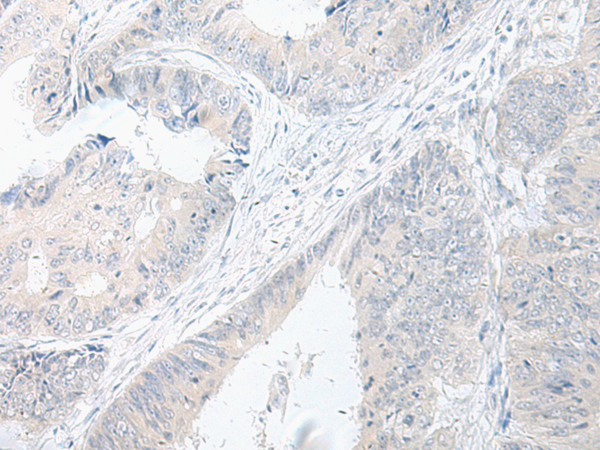 Immunohistochemistry of paraffin-embedded Human colorectal cancer tissue  using GPRASP2 Polyclonal Antibody at dilution of 1:75(×200)