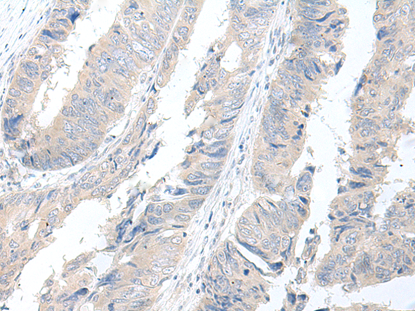 Immunohistochemistry of paraffin-embedded Human colorectal cancer tissue  using GBA2 Polyclonal Antibody at dilution of 1:55(×200)