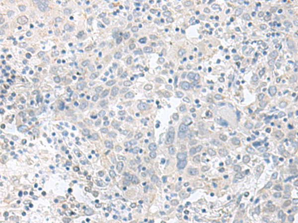 Immunohistochemistry of paraffin-embedded Human cervical cancer tissue  using TIMM8A Polyclonal Antibody at dilution of 1:90(×200)