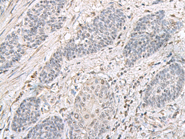 Immunohistochemistry of paraffin-embedded Human esophagus cancer tissue  using EPM2A Polyclonal Antibody at dilution of 1:75(×200)