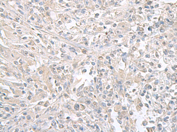 Immunohistochemistry of paraffin-embedded Human liver cancer tissue  using FXYD6 Polyclonal Antibody at dilution of 1:65(×200)