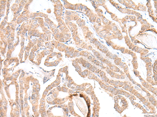 Immunohistochemistry of paraffin-embedded Human thyroid cancer tissue  using PLGLB2 Polyclonal Antibody at dilution of 1:35(×200)