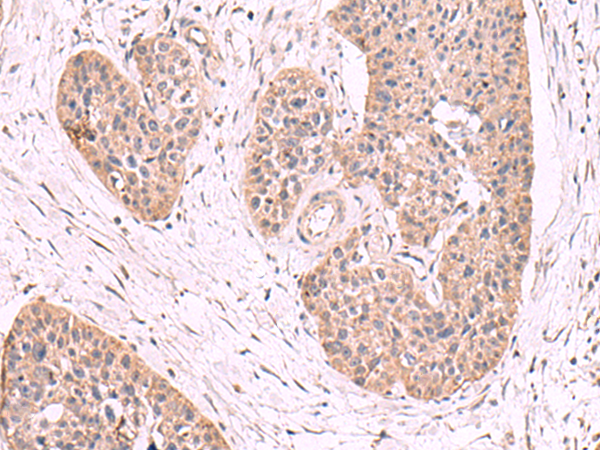 Immunohistochemistry of paraffin-embedded Human esophagus cancer tissue  using MGP Polyclonal Antibody at dilution of 1:50(×200)