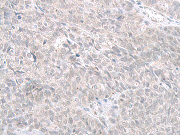 Immunohistochemistry of paraffin-embedded Human ovarian cancer tissue  using STAU2 Polyclonal Antibody at dilution of 1:60(×200)