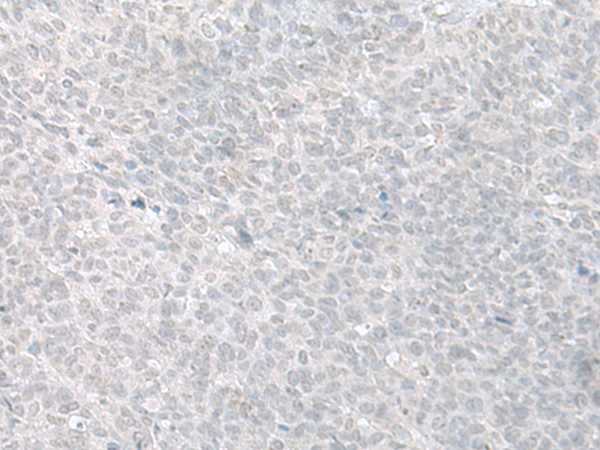 Immunohistochemistry of paraffin-embedded Human ovarian cancer tissue  using C8orf4 Polyclonal Antibody at dilution of 1:70(×200)