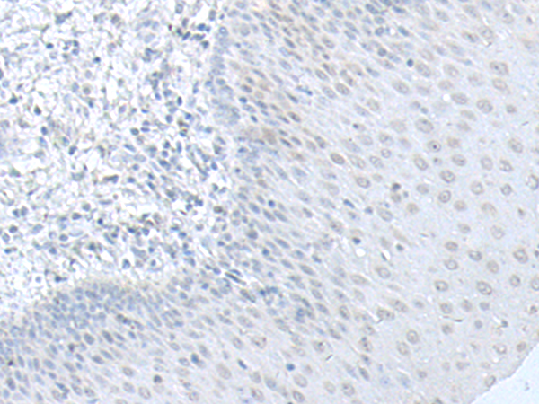 Immunohistochemistry of paraffin-embedded Human esophagus cancer tissue  using C8orf4 Polyclonal Antibody at dilution of 1:70(×200)