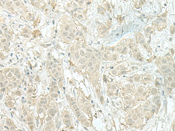 Immunohistochemistry of paraffin-embedded Human breast cancer tissue  using MIEN1 Polyclonal Antibody at dilution of 1:100(×200)