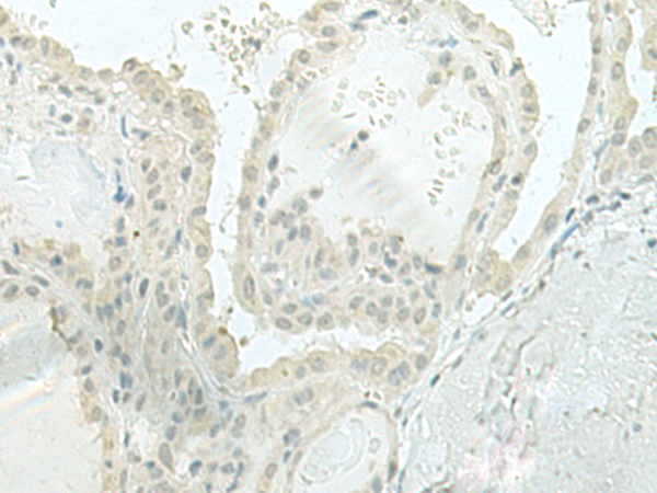 Immunohistochemistry of paraffin-embedded Human thyroid cancer tissue  using MIEN1 Polyclonal Antibody at dilution of 1:100(×200)