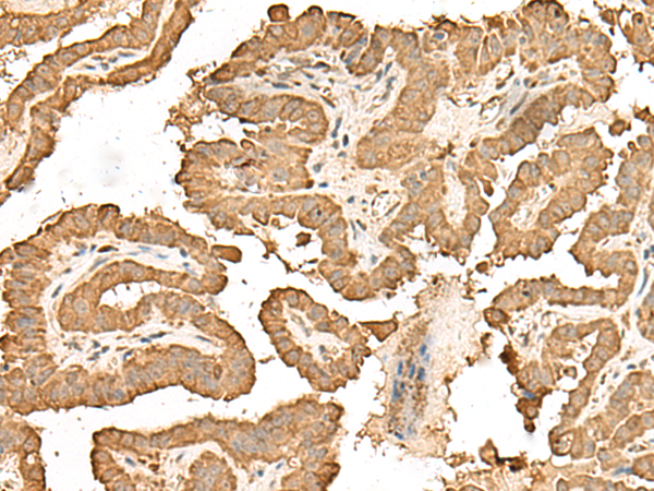 Immunohistochemistry of paraffin-embedded Human thyroid cancer tissue  using RPS25 Polyclonal Antibody at dilution of 1:65(×200)