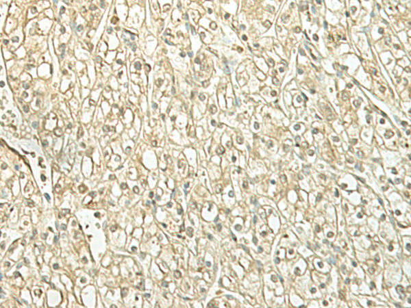 Immunohistochemistry of paraffin-embedded Human kidney cancer tissue  using SPIRE1 Polyclonal Antibody at dilution of 1:60(×200)