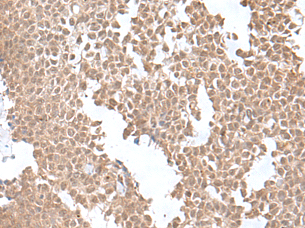 Immunohistochemistry of paraffin-embedded Human ovarian cancer tissue  using SNRNP25 Polyclonal Antibody at dilution of 1:55(×200)