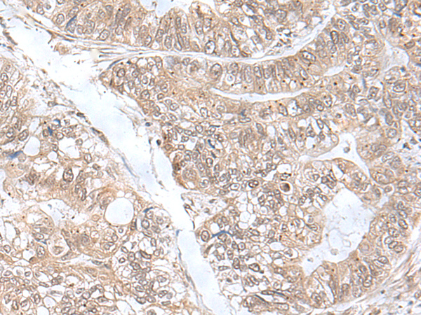 Immunohistochemistry of paraffin-embedded Human gastric cancer tissue  using SNRNP25 Polyclonal Antibody at dilution of 1:55(×200)