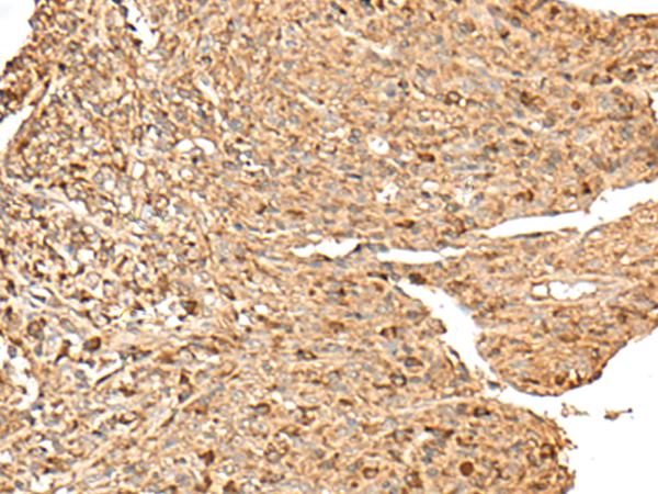 Immunohistochemistry of paraffin-embedded Human liver cancer tissue  using RPS12 Polyclonal Antibody at dilution of 1:70(×200)